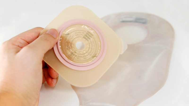 人工肛門（ストーマ）管理